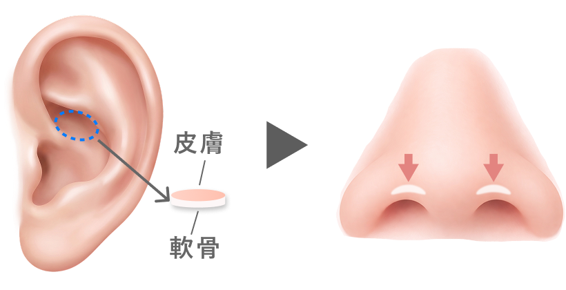 重症例