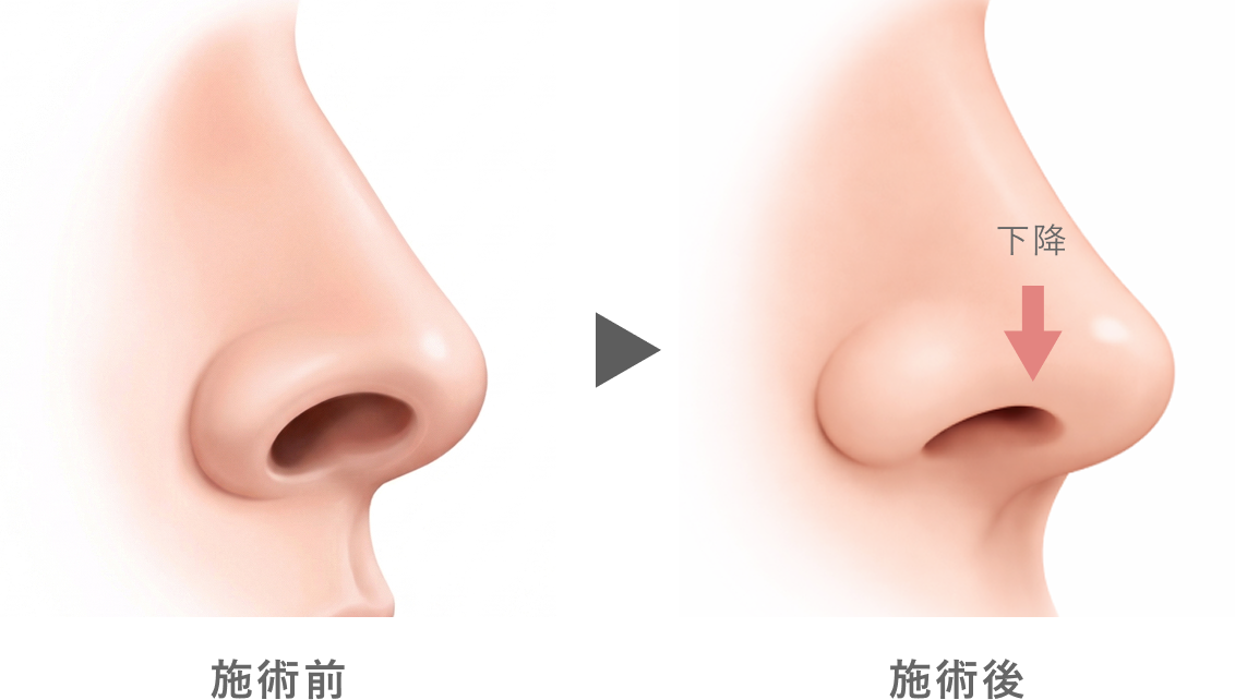 鼻孔縁下降術の効果