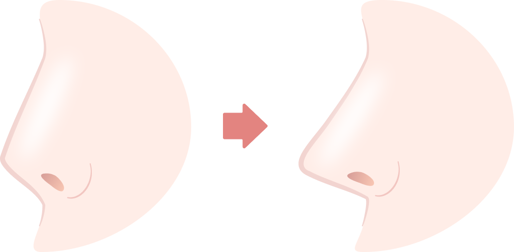 鼻中隔延長術