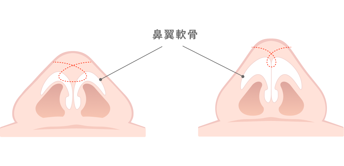 鼻尖形成術