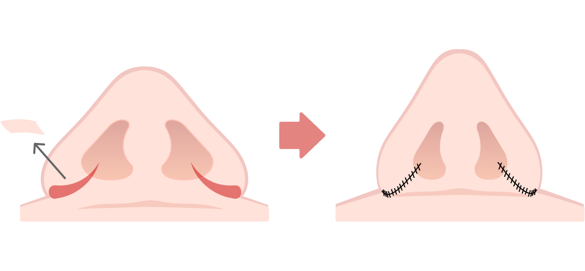 小鼻縮小術（鼻翼縮小）