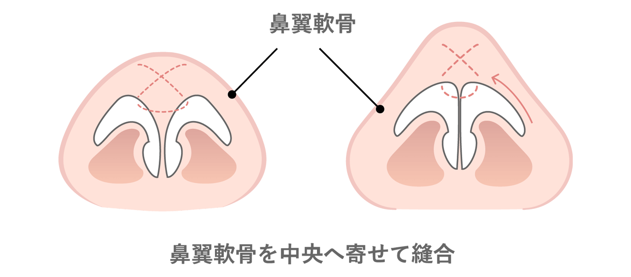 鼻尖形成術とは