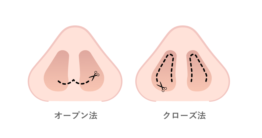 皮膚を切開