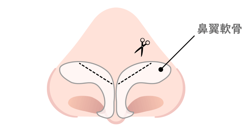  鼻翼軟骨を切除する