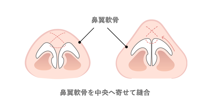 鼻翼軟骨間の縫合