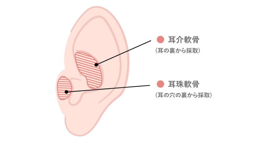 （必要に応じて）鼻尖に耳珠軟骨を移植