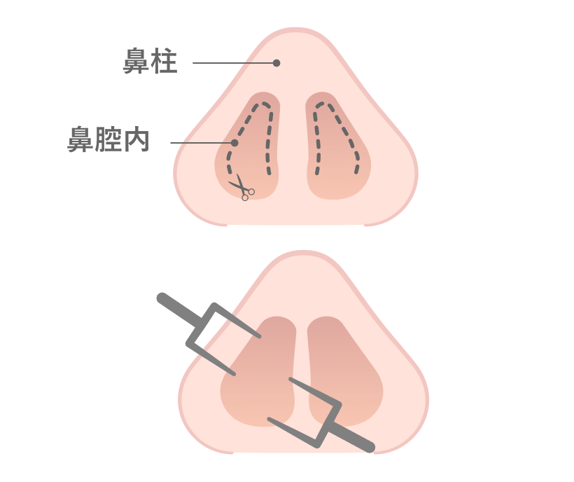 クローズド法