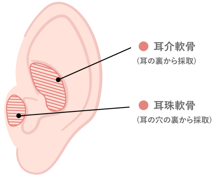 鼻先軟骨移植（耳介耳珠軟骨）とは