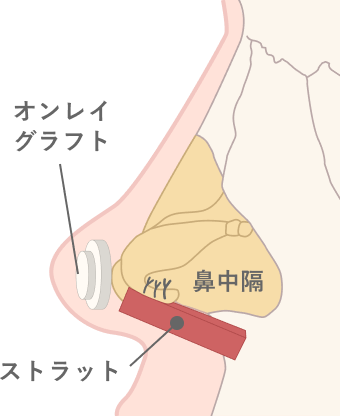 コルメラストラット法