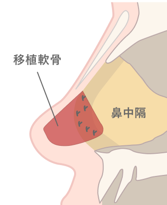 コルメラストラット法