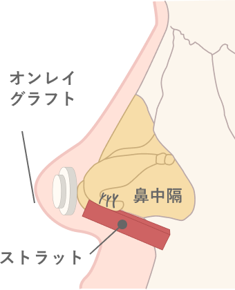 軟骨移植術