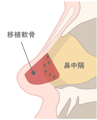 鼻中隔延長術