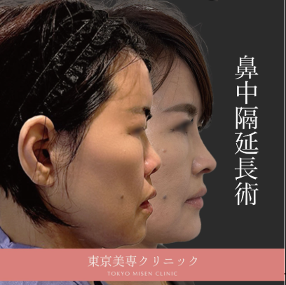 鼻中隔延長術