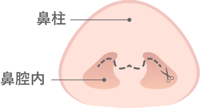 鼻中隔延長術