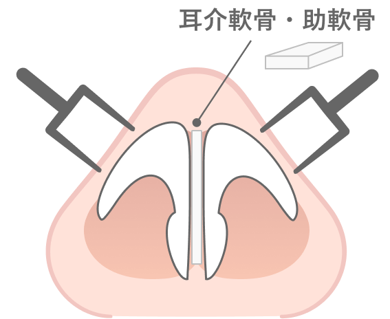 鼻中隔延長術