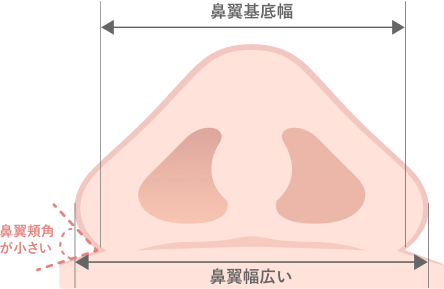 鼻翼基底幅はさほど広くないが、鼻翼幅が広い鼻