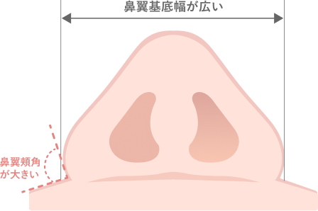 鼻翼基底幅が広いに対する鼻孔底縮小