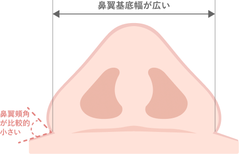 鼻翼幅と鼻翼基底幅の両方が広いに対する鼻翼・鼻孔底縮小