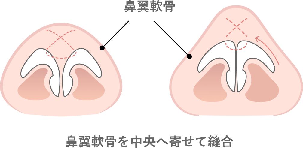 鼻尖形成術（団子鼻解消術）