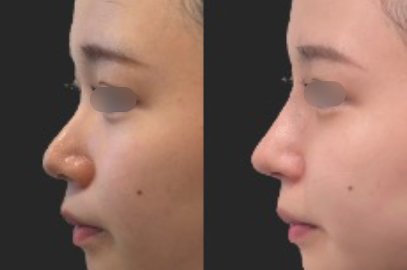 プロテーゼ・鼻尖形成(closed)・耳介耳珠軟骨移植（コルメラストラット含む）・鼻柱下降・鼻翼縮小・鼻翼挙上