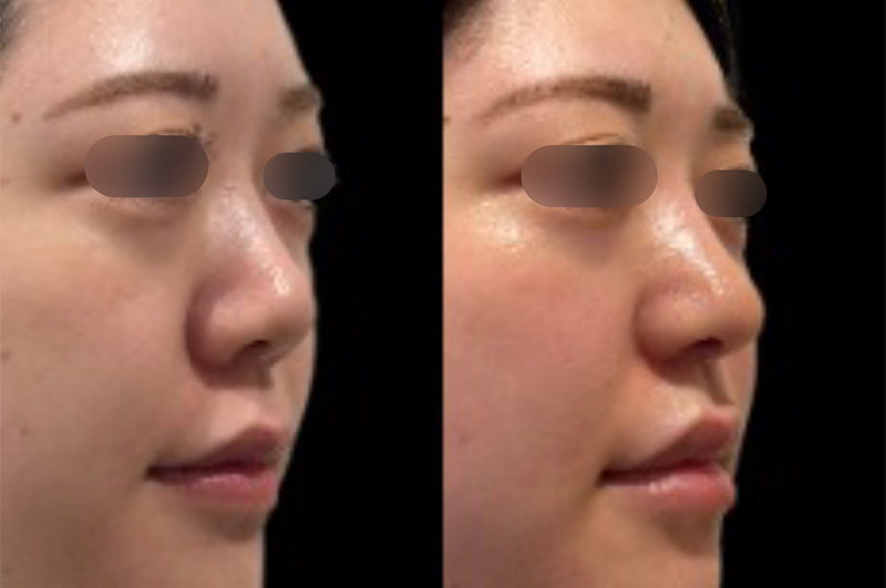 プロテーゼ・鼻尖形成(closed)・耳介耳珠軟骨移植（コルメラストラット含む）・鼻柱下降・鼻翼縮小(内外側)・鼻翼挙上