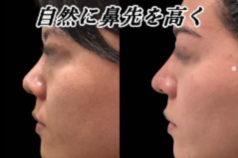 鼻尖形成(closed)・耳介耳珠軟骨移植（コルメラストラット含む）・鼻柱下降・鼻翼縮小・鼻翼挙上