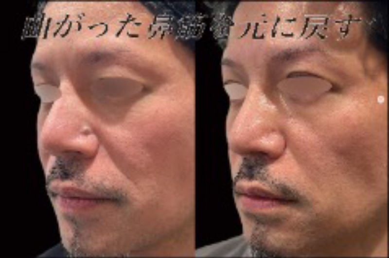 プロテーゼ入れ直し（他院修正）・鼻尖形成(closed)・耳介耳珠軟骨移植（コルメラストラット含む）・鼻柱下降・鼻翼縮小・鼻翼挙上・黒子除去