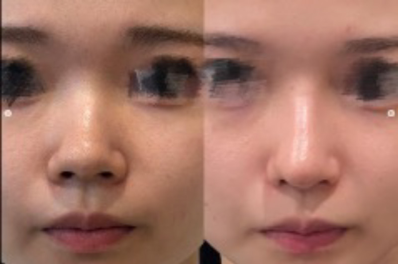 プロテーゼ・鼻尖形成(closed)・耳介耳珠軟骨移植（コルメラストラット含む）・鼻柱下降・鼻翼縮小・鼻翼挙上