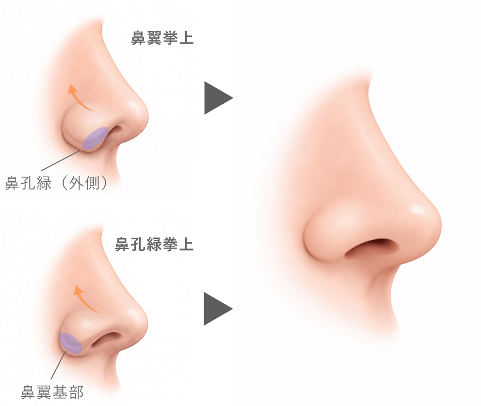 鼻孔縁挙上術の効果