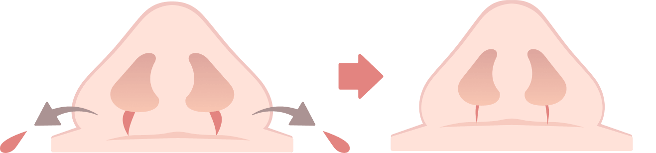 小鼻縮小術（鼻翼縮小）