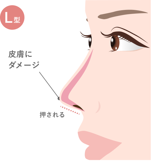 L型プロテーゼ