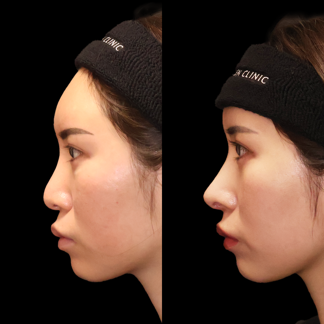 Before and after: Septal Extension + Tip Refinement + Nasal Tip Cartilage Grafting + Columella Lowering + Nasolabial Angle Correction