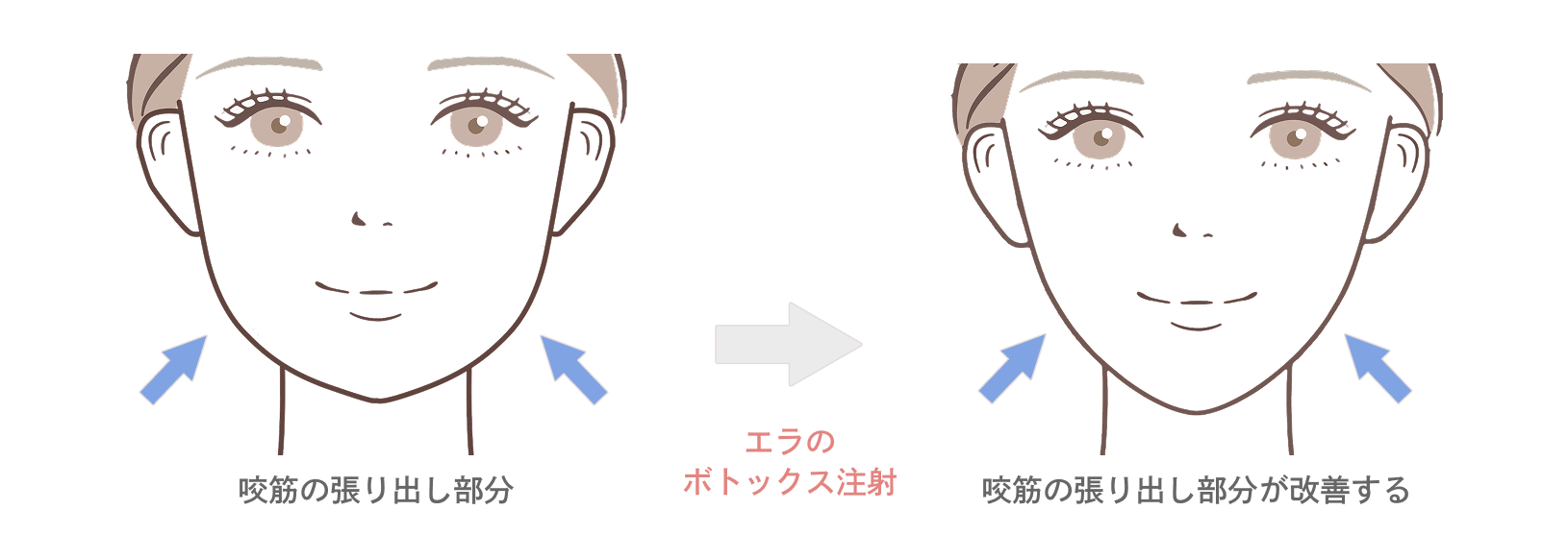 エラのボトックス注射の効果