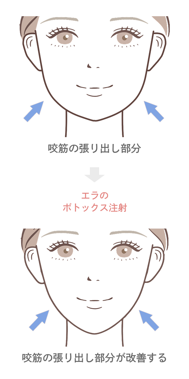 エラのボトックス注射の効果