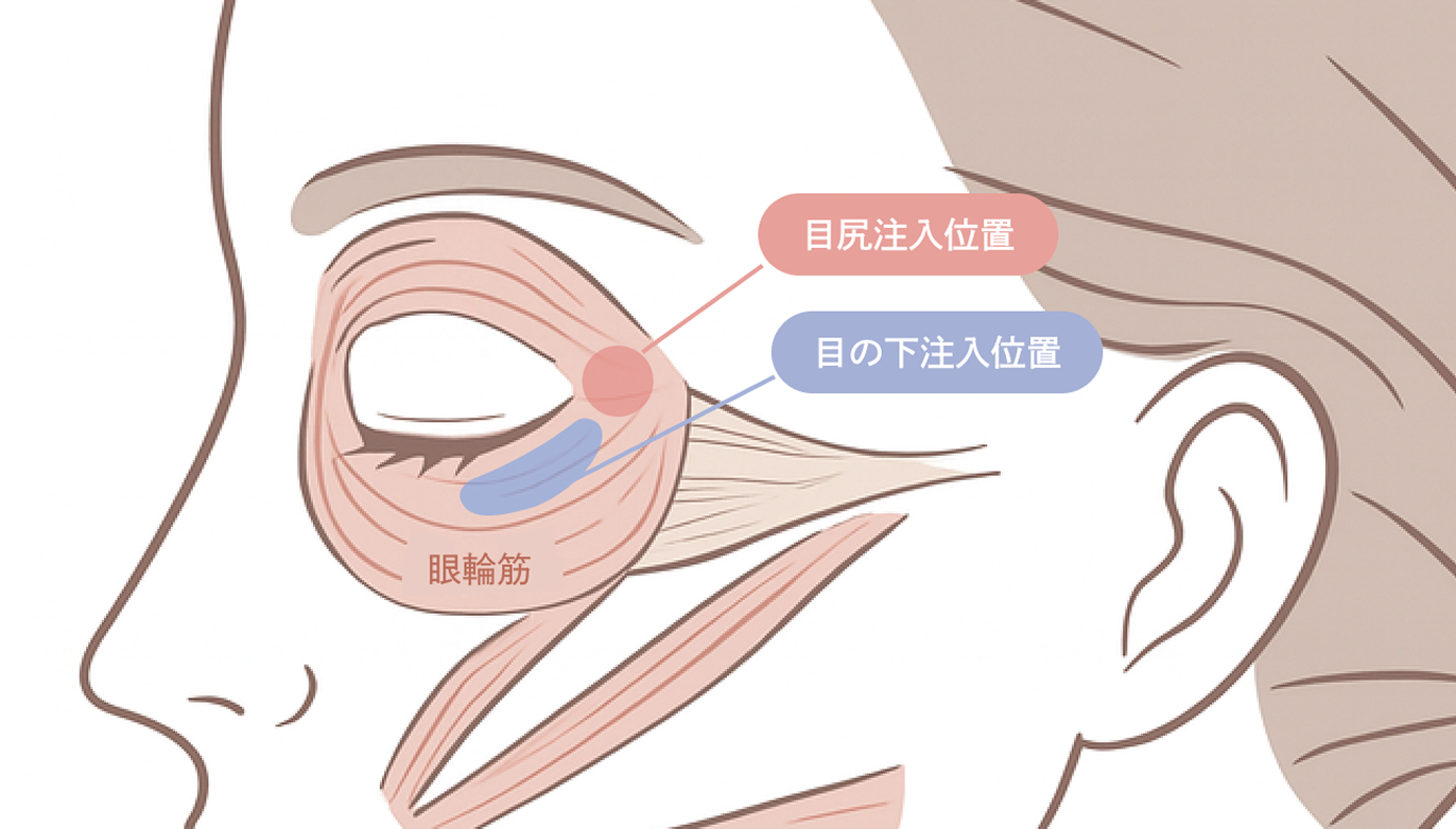 額・眉間・バニーラインのボトックス注射とは