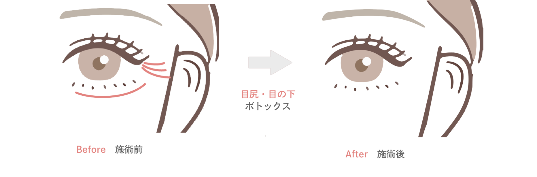 エラのボトックス注射の効果