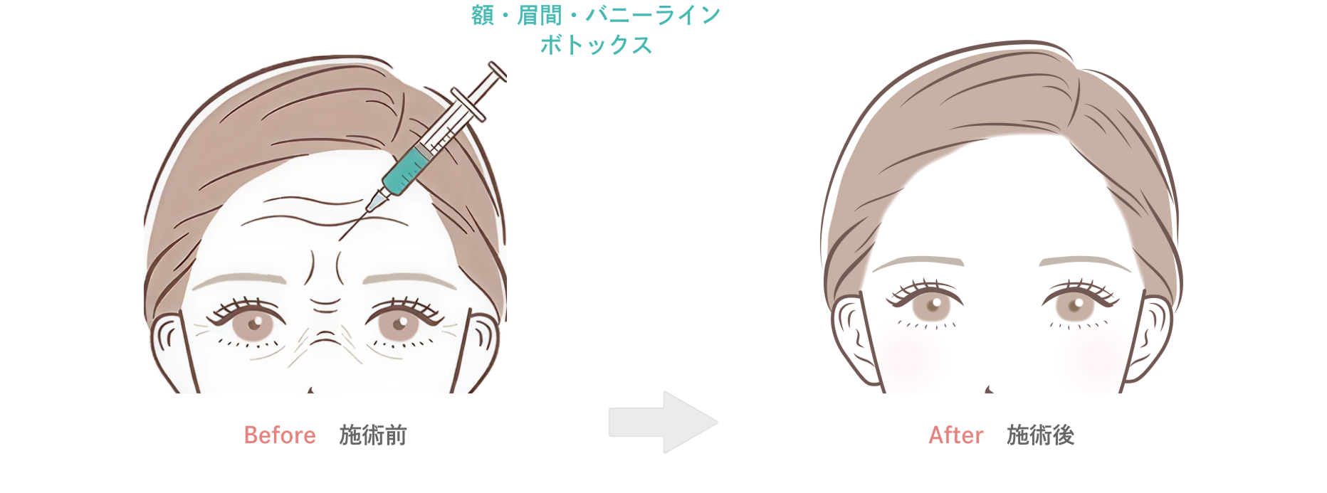 エラのボトックス注射の効果