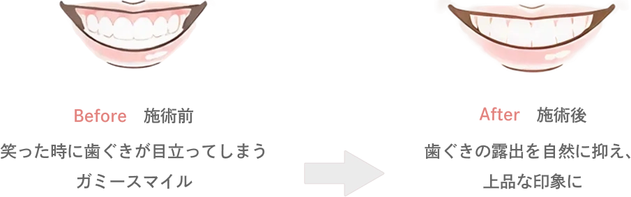 ガミースマイルのボトックスの効果