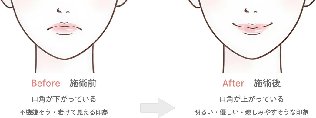 口角のボトックスの効果