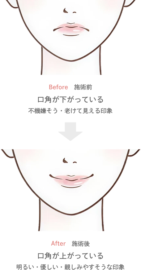 口角のボトックスの効果