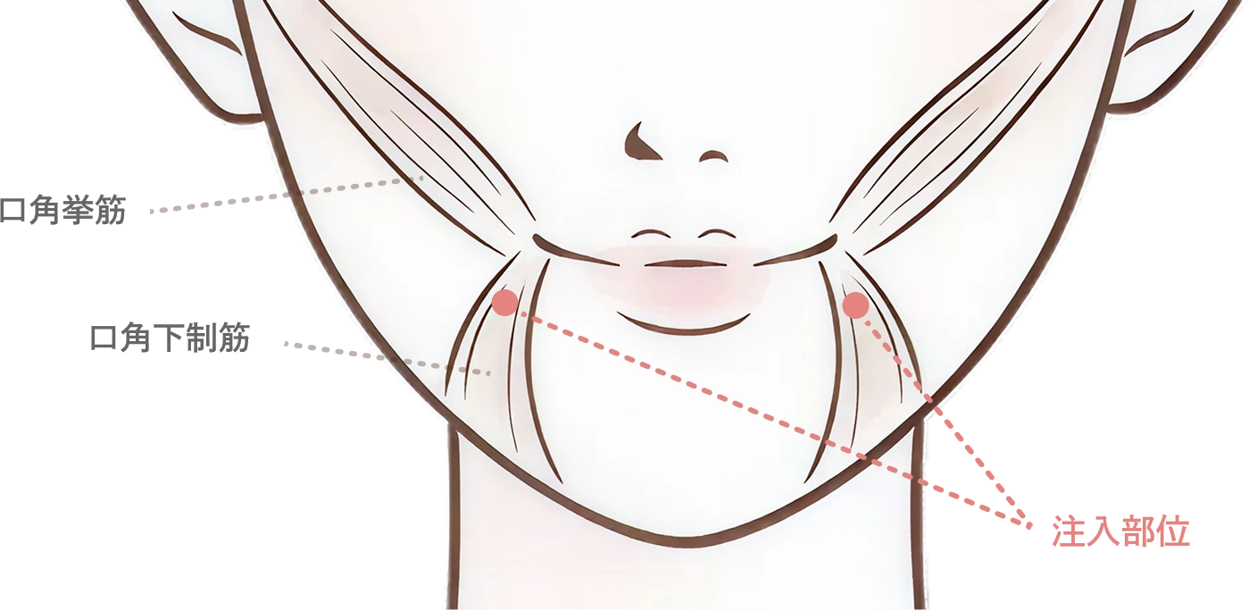 口角のボトックス注射とは