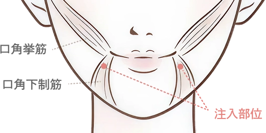 口角のボトックス注射とは