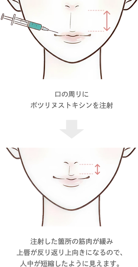 人中のボトックスの効果