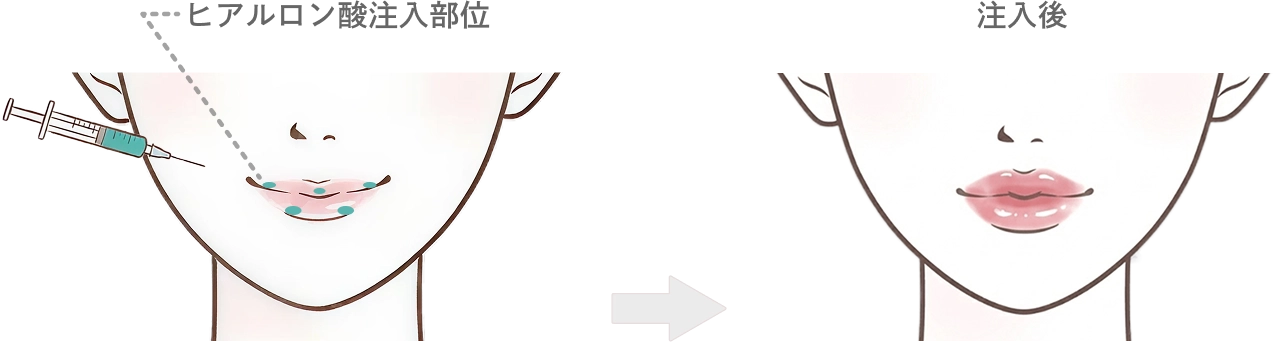 唇のヒアルロン酸注入