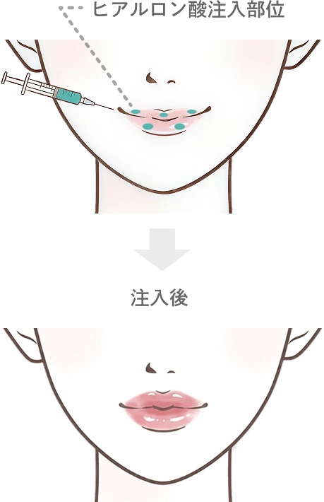 唇のヒアルロン酸注入