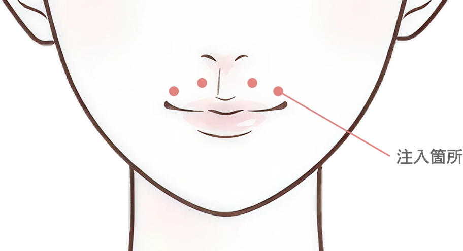 人中のボトックス注射とは