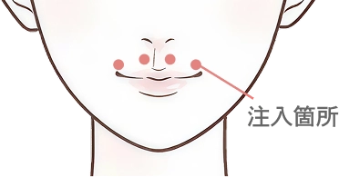 人中のボトックス注射とは