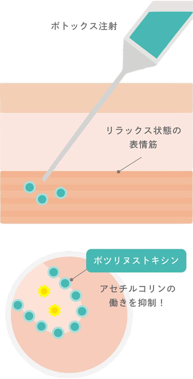 ボツリヌストキシン治療