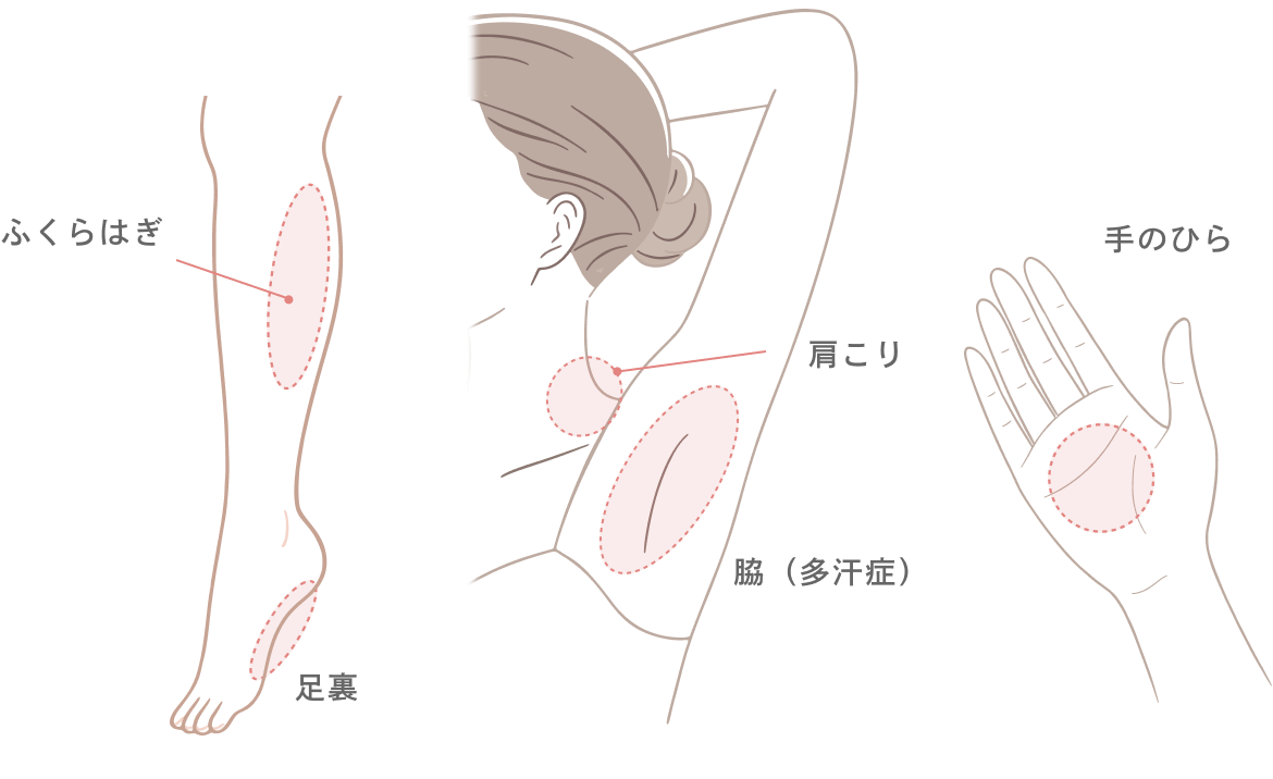 ボツリヌストキシン治療