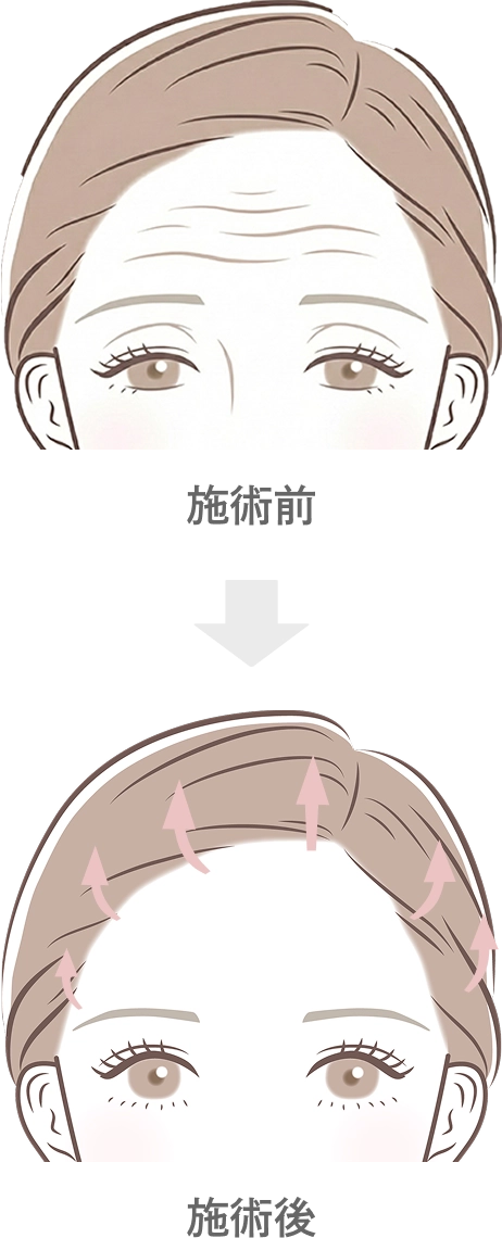前額リフトの効果